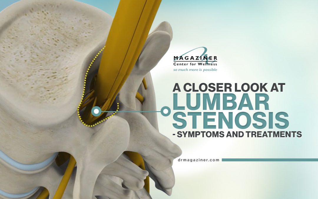 A Closer Look at Lumbar Stenosis – Symptoms and Treatments